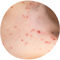 Chickenpox rash