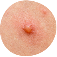 Chickenpox blister