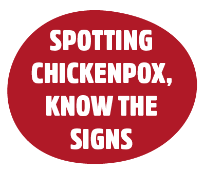 Spotting chickenpox, know the signs. Learn what to look for by clicking here.